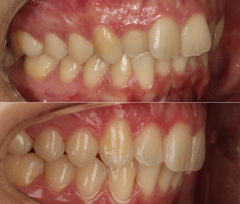 Clear Currect before after