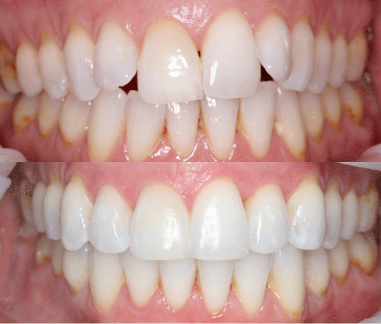 Clear Currect before after