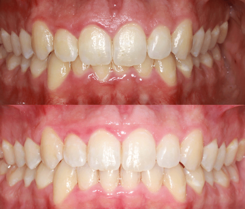 Clear Currect before after