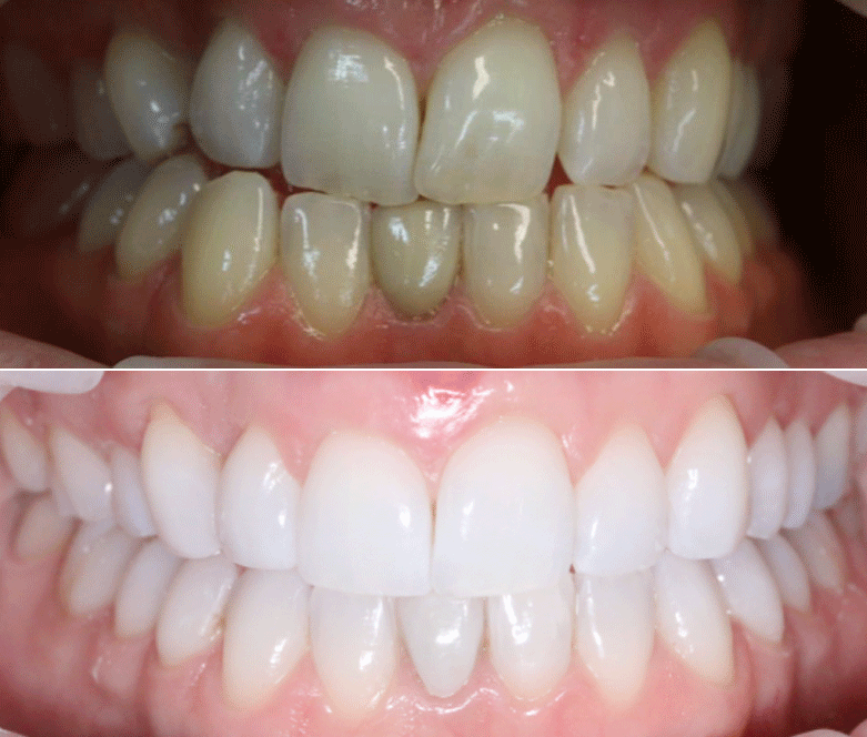 Clear Currect before after