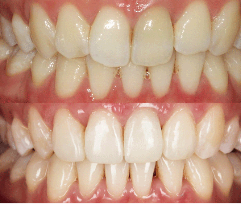 Clear Currect before after