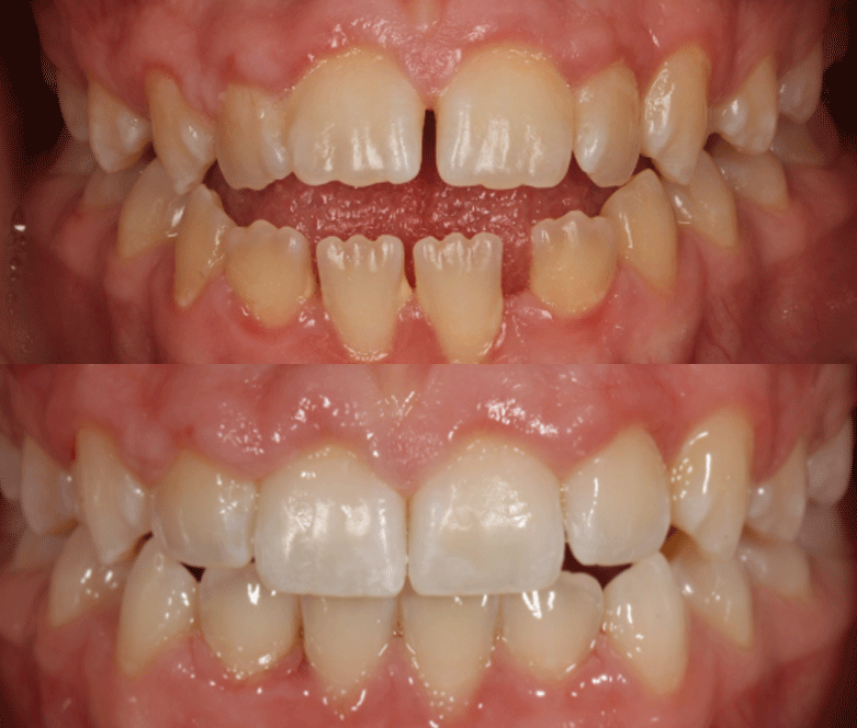 Clear Currect before after