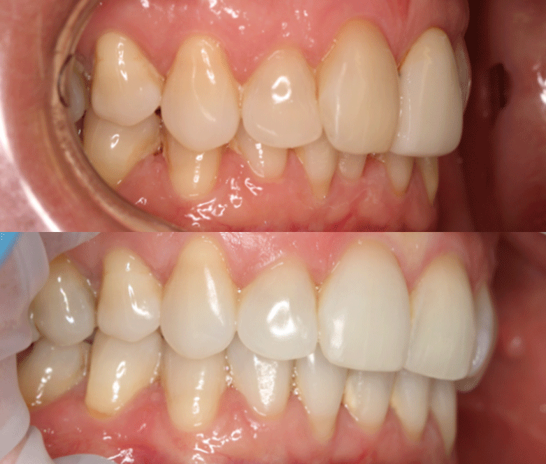 Clear Currect before after