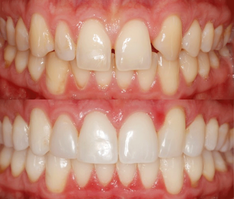 Clear Currect before after